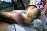 Một bệnh nhân mắc chứng bệnh chưa từng thấy tại Việt Nam
