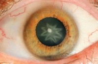 Hình sao xuất hiện trong mắt sau khi bị đấm