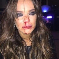 Cựu người mẫu Anh bị đánh toàn thân bê bết máu, tội nghiệp nhìn gương mặt tàn tạ quá @@
