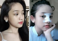 Nữ sinh 17 tuổi ở Cà Mau - tình địch của Midu không ngại công khai hình chụp trong giai đoạn phẫu thuật thẩm mỹ.