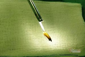 Gắp hạt thóc chui vào dương vật của bệnh nhân 33 tuổi