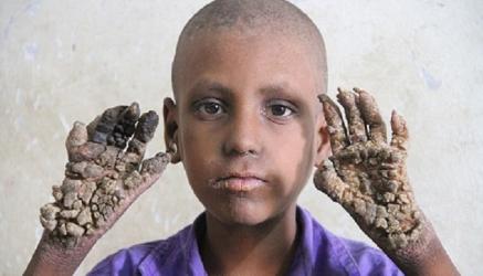 Mắc căn bệnh lạ, cậu bé 7 tuổi ở Bangladesh có chân tay sần sùi như rễ cây
