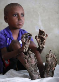 Mắc căn bệnh lạ, cậu bé 7 tuổi ở Bangladesh có chân tay sần sùi như rễ cây