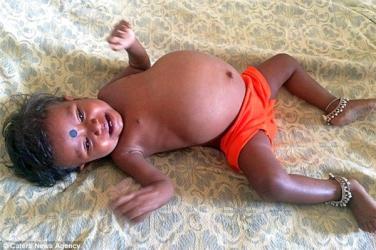 Bé gái 15 tháng tuổi mang bào thai nặng 3,5kg trong cơ thể